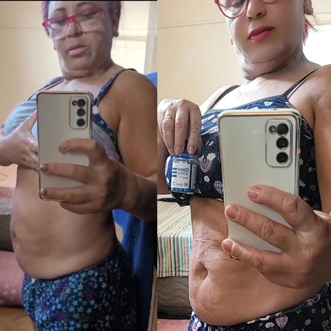Antes e depois do uso de Ozenvitta — perda de peso visível